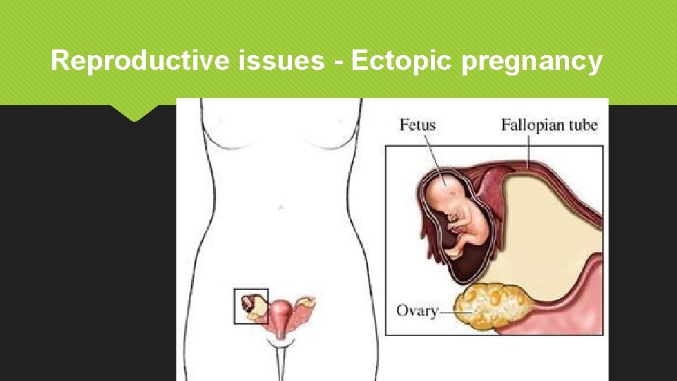 Reproductive issues - Ectopic pregnancy 