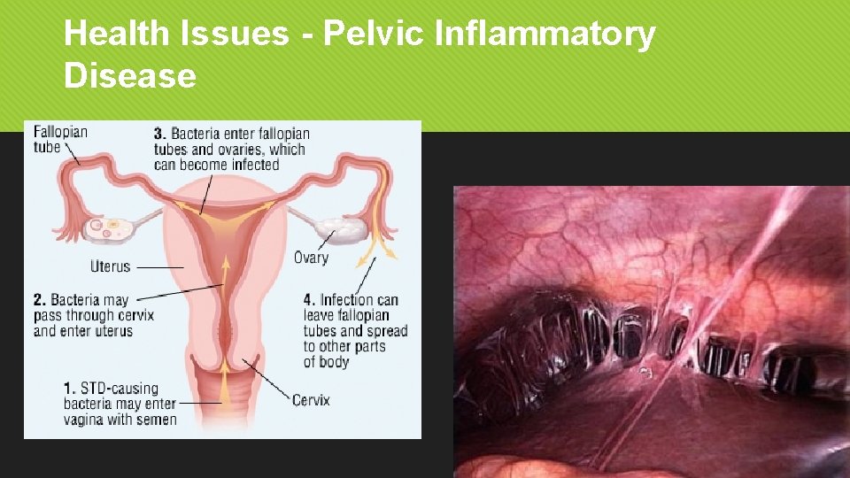 Health Issues - Pelvic Inflammatory Disease 