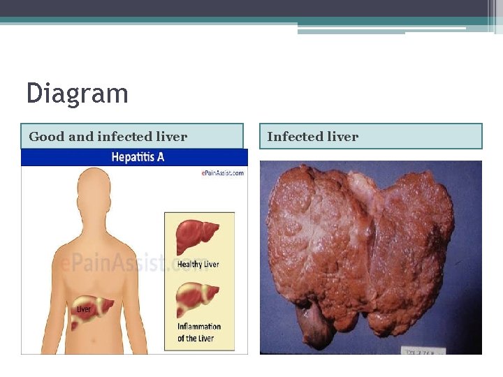 Diagram Good and infected liver Infected liver 