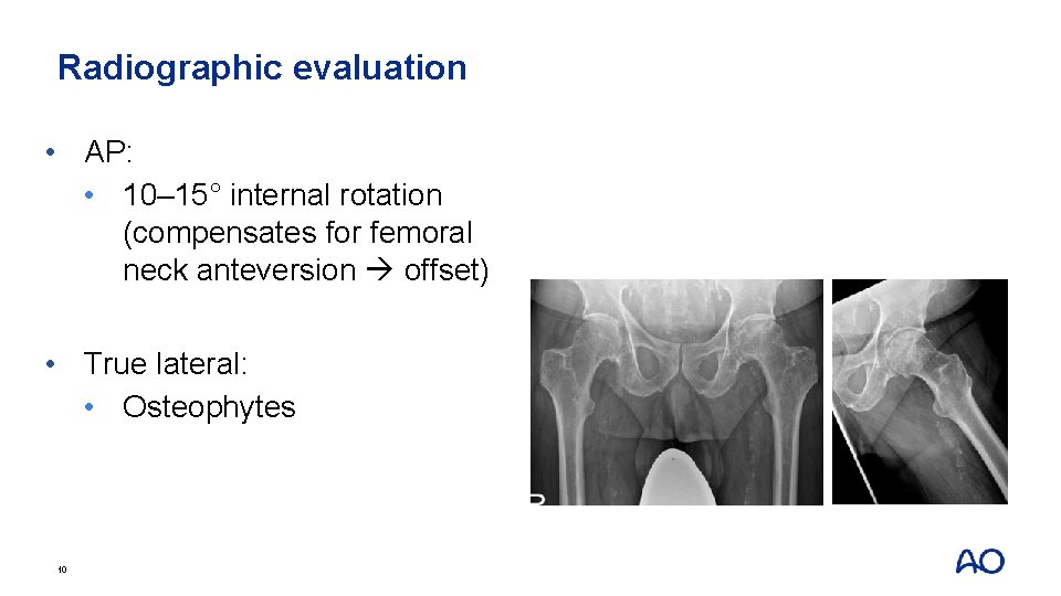 Radiographic evaluation • AP: • 10– 15° internal rotation (compensates for femoral neck anteversion