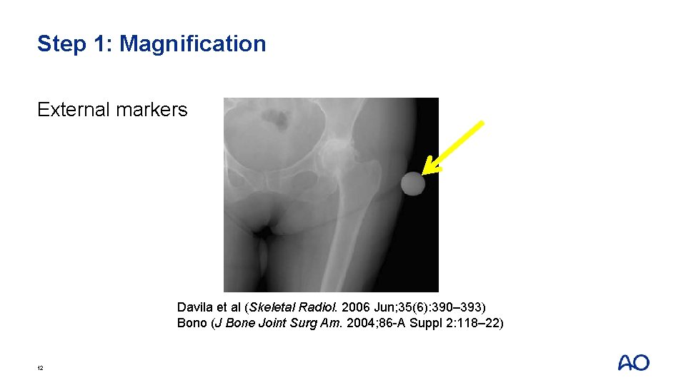 Step 1: Magnification External markers Davila et al (Skeletal Radiol. 2006 Jun; 35(6): 390–