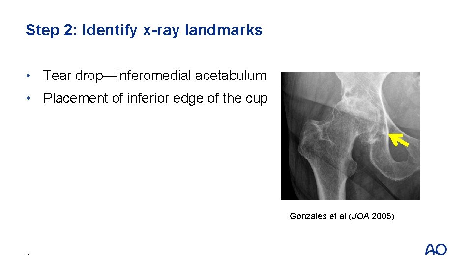 Step 2: Identify x-ray landmarks • Tear drop—inferomedial acetabulum • Placement of inferior edge
