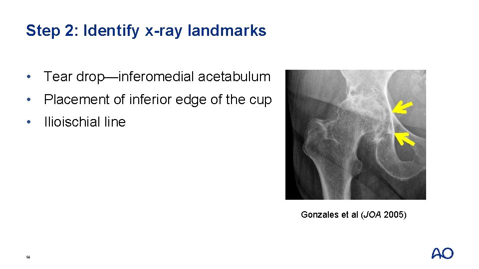 Step 2: Identify x-ray landmarks • Tear drop—inferomedial acetabulum • Placement of inferior edge