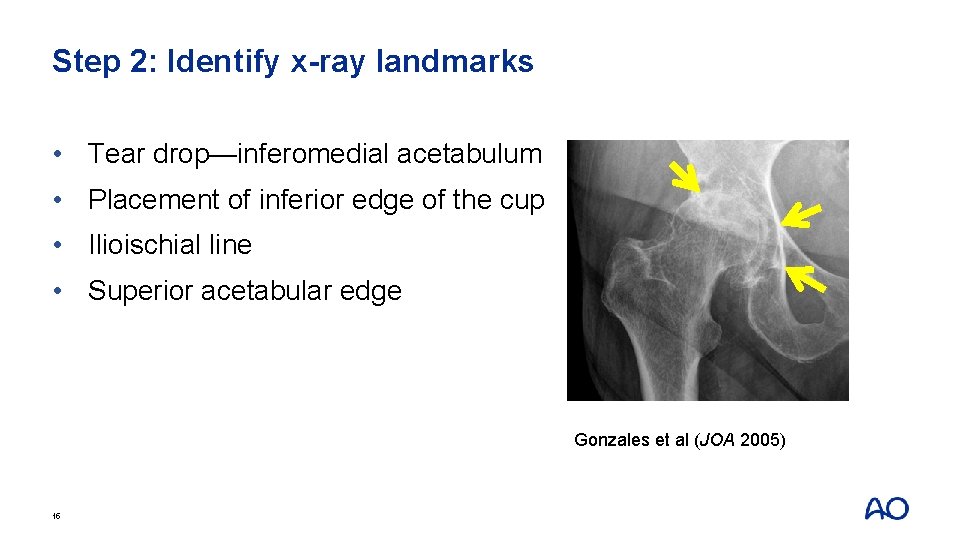 Step 2: Identify x-ray landmarks • Tear drop—inferomedial acetabulum • Placement of inferior edge