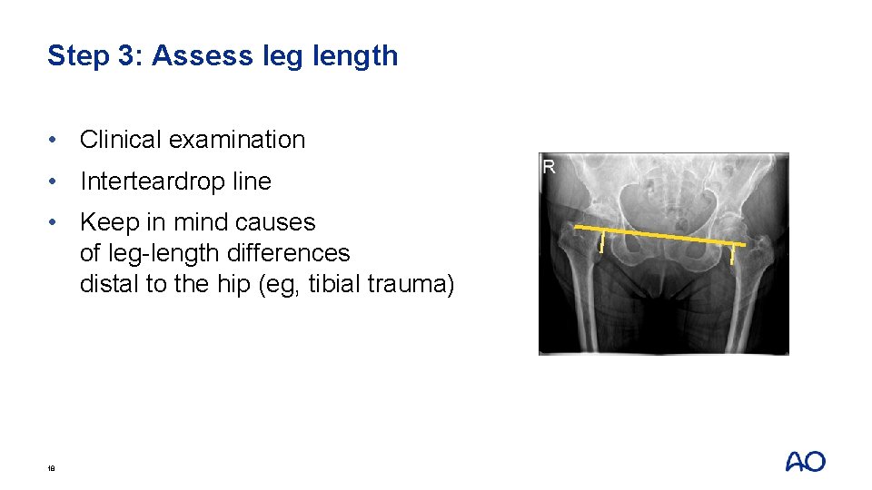 Step 3: Assess leg length • Clinical examination • Interteardrop line • Keep in