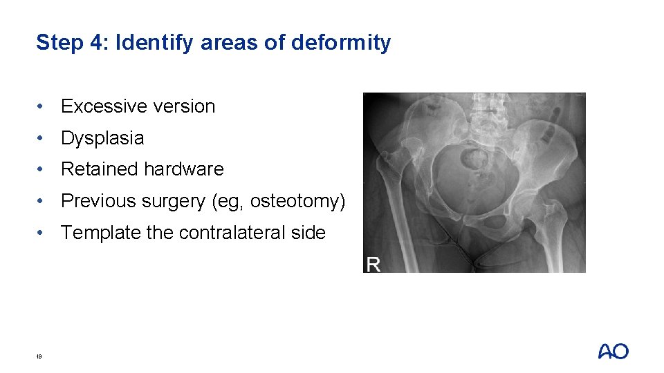 Step 4: Identify areas of deformity • Excessive version • Dysplasia • Retained hardware
