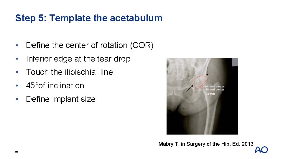 Step 5: Template the acetabulum • Define the center of rotation (COR) • Inferior