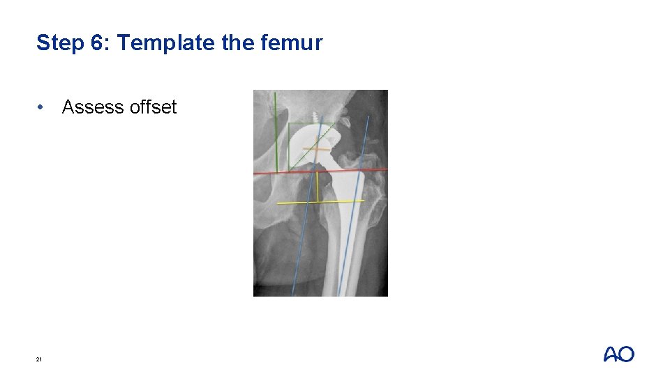 Step 6: Template the femur • Assess offset 21 