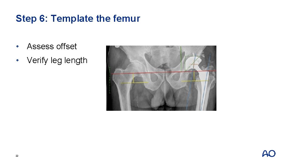 Step 6: Template the femur • Assess offset • Verify leg length 22 