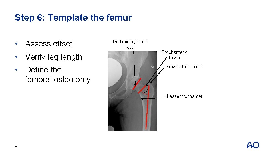 Step 6: Template the femur • Assess offset Preliminary neck cut Trochanteric fossa •