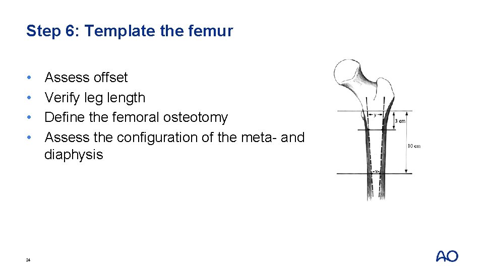 Step 6: Template the femur • • 24 Assess offset Verify leg length Define