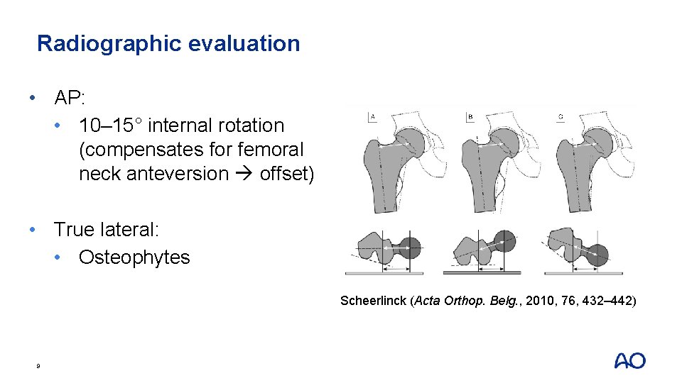 Radiographic evaluation • AP: • 10– 15° internal rotation (compensates for femoral neck anteversion
