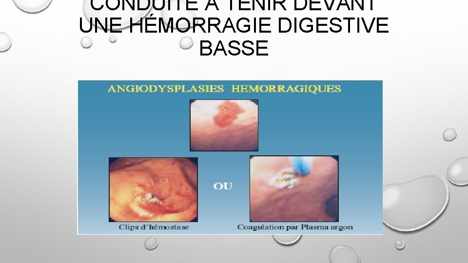 CONDUITE À TENIR DEVANT UNE HÉMORRAGIE DIGESTIVE BASSE 