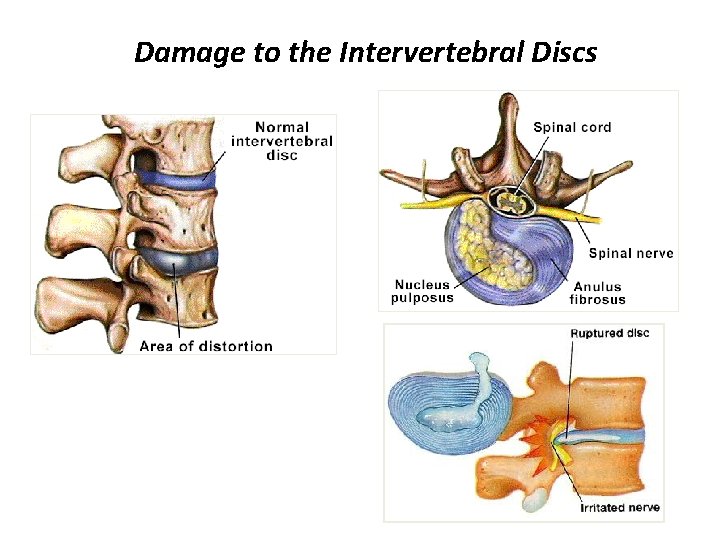 Damage to the Intervertebral Discs 