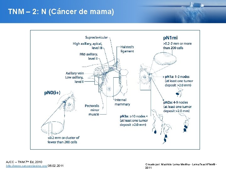 TNM – 2: N (Cáncer de mama) AJCC – TNM 7 th Ed, 2010