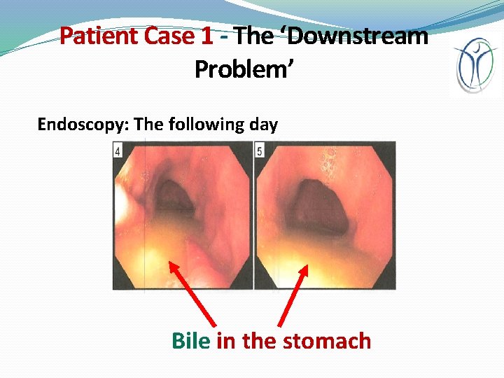 Patient Case 1 - The ‘Downstream Problem’ Endoscopy: The following day Bile in the