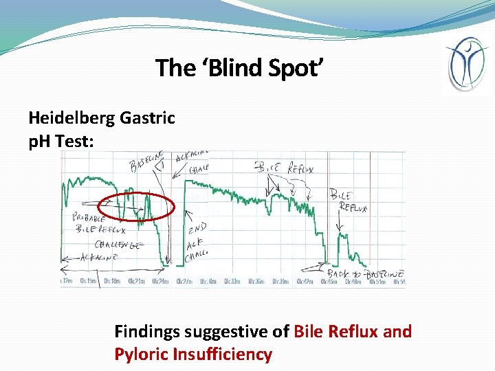 The ‘Blind Spot’ Heidelberg Gastric p. H Test: Findings suggestive of Bile Reflux and