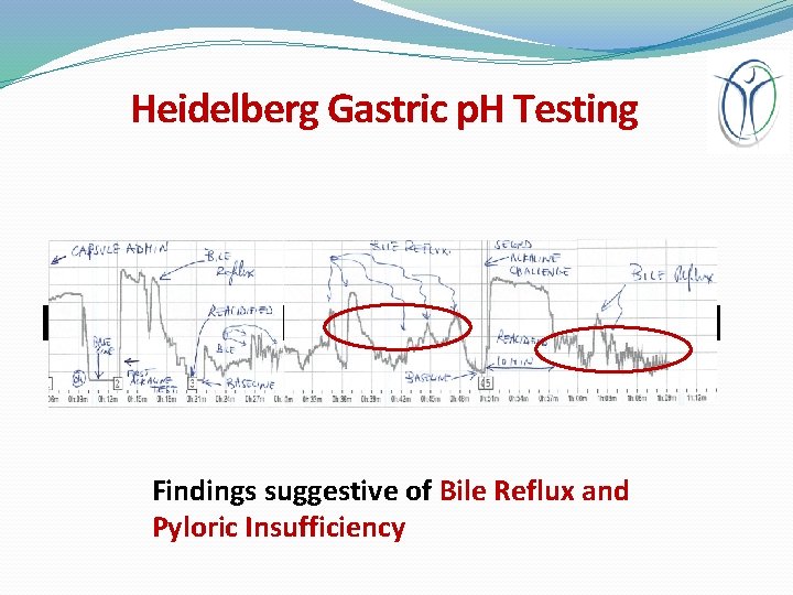 Heidelberg Gastric p. H Testing Findings suggestive of Bile Reflux and Pyloric Insufficiency 