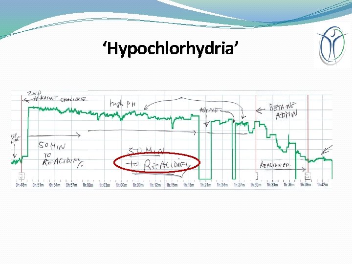 ‘Hypochlorhydria’ 