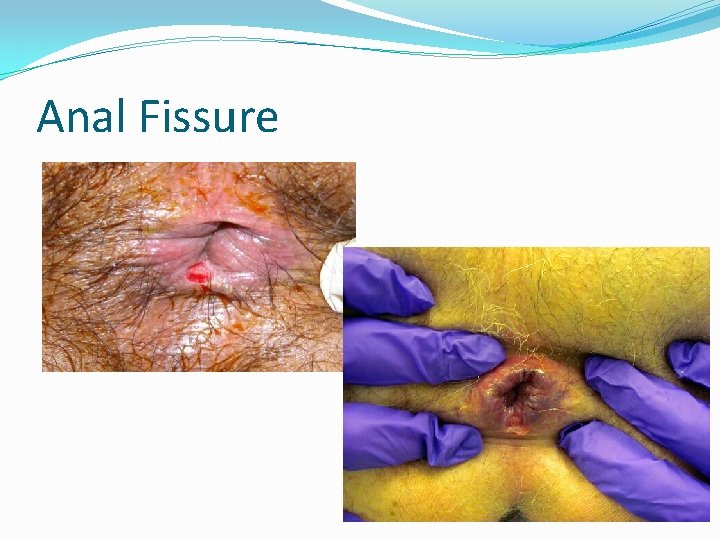 Anal Fissure 