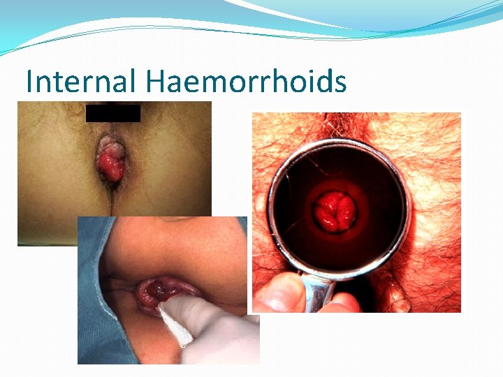 Internal Haemorrhoids 