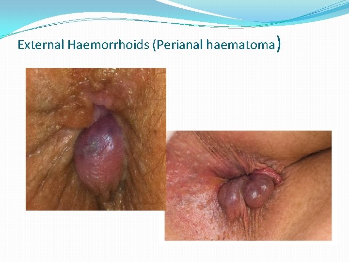 External Haemorrhoids (Perianal haematoma) 