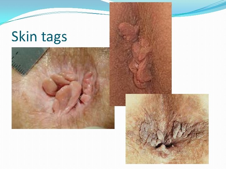 Skin tags 