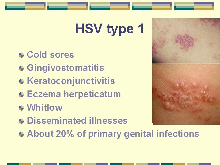 HSV type 1 Cold sores Gingivostomatitis Keratoconjunctivitis Eczema herpeticatum Whitlow Disseminated illnesses About 20%