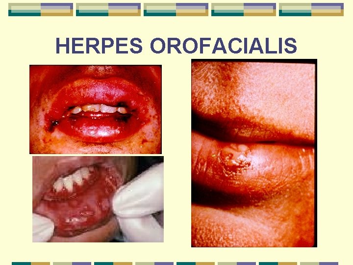 HERPES OROFACIALIS 
