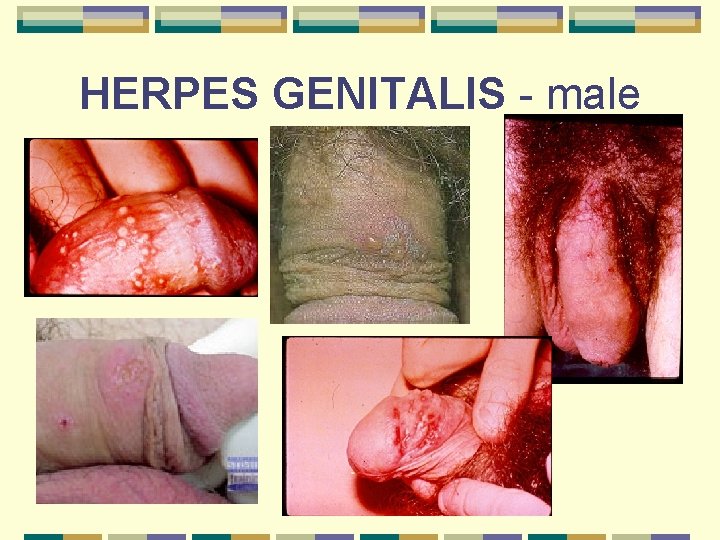 HERPES GENITALIS - male 