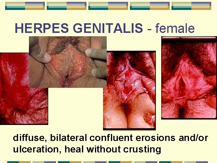 HERPES GENITALIS - female diffuse, bilateral confluent erosions and/or ulceration, heal without crusting 
