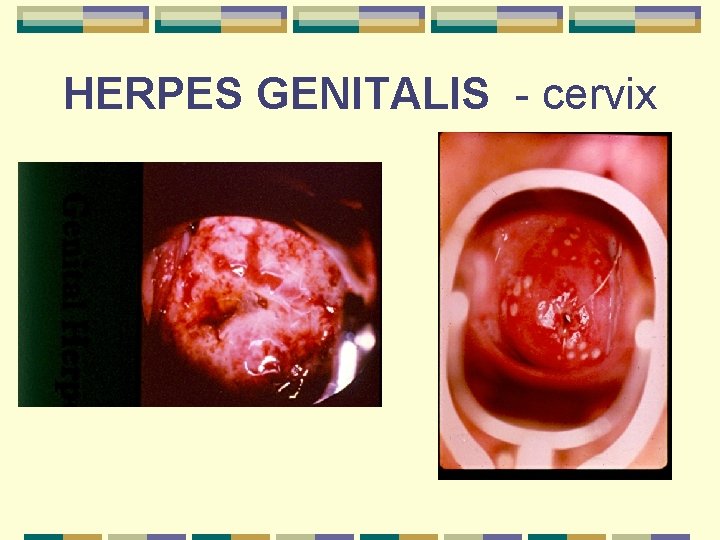HERPES GENITALIS - cervix 