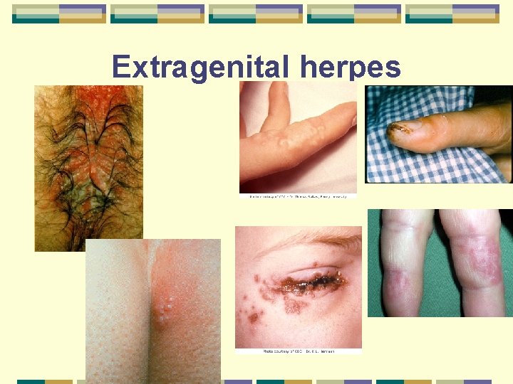 Extragenital herpes 