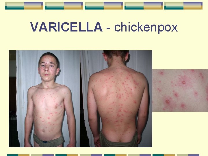 VARICELLA - chickenpox 