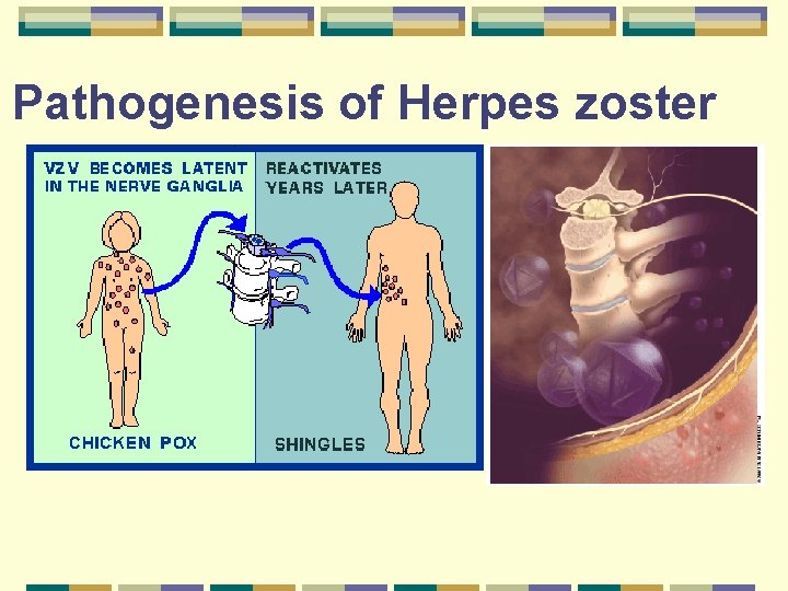 Pathogenesis of Herpes zoster 