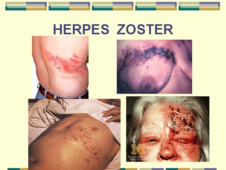 HERPES ZOSTER 
