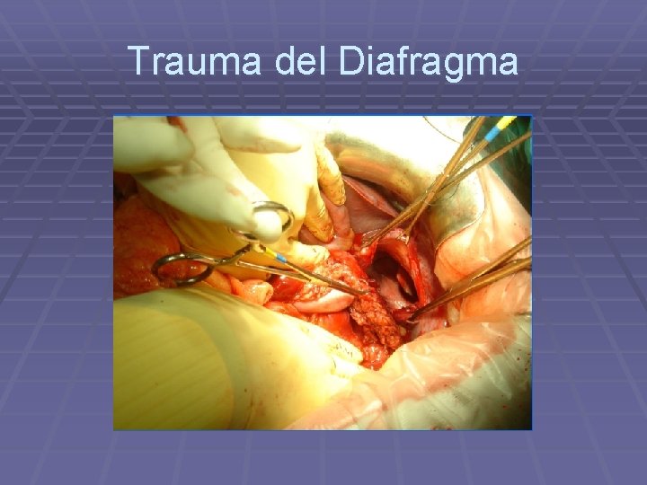 Trauma del Diafragma 