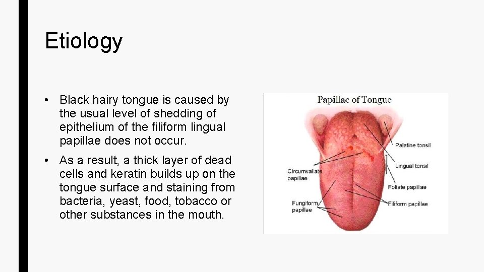 Etiology • Black hairy tongue is caused by the usual level of shedding of