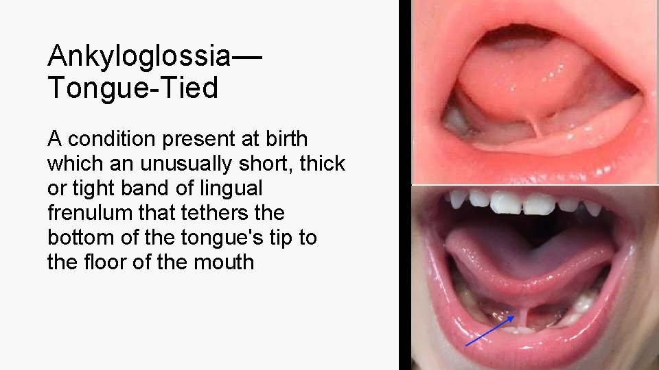 Ankyloglossia— Tongue-Tied A condition present at birth which an unusually short, thick or tight