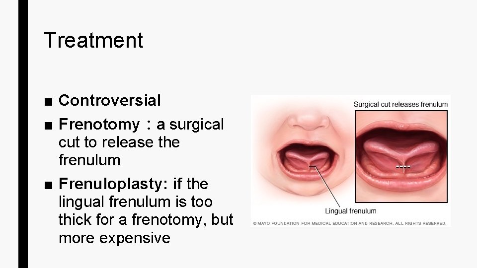 Treatment ■ Controversial ■ Frenotomy：a surgical cut to release the frenulum ■ Frenuloplasty: if