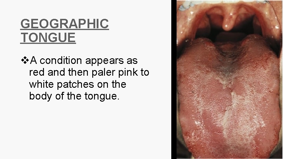 GEOGRAPHIC TONGUE v. A condition appears as red and then paler pink to white