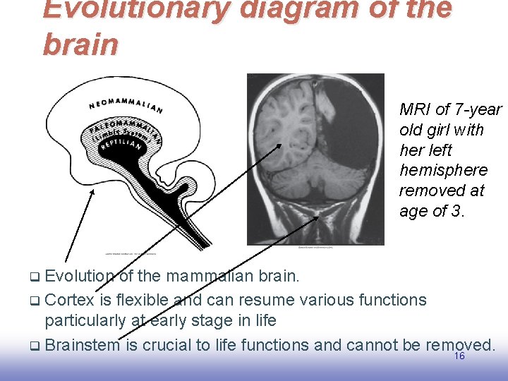 Evolutionary diagram of the brain MRI of 7 -year old girl with her left