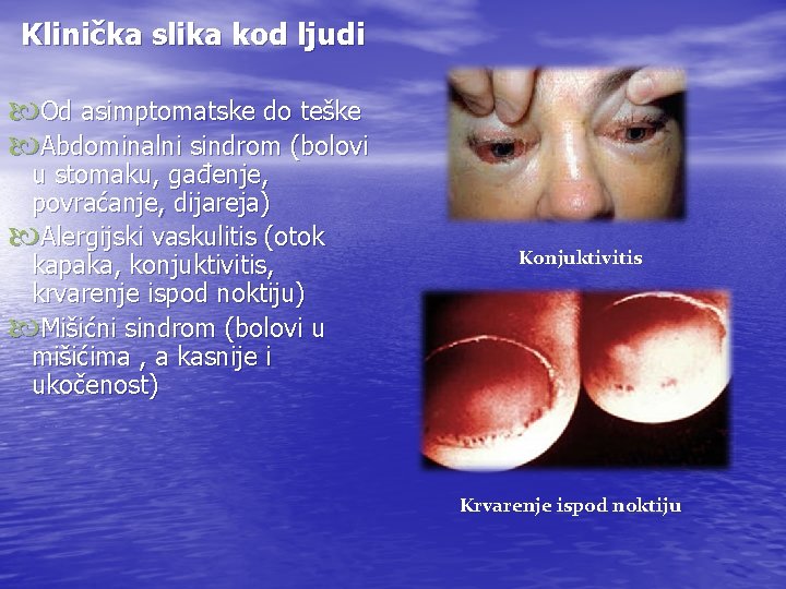 Klinička slika kod ljudi Od asimptomatske do teške Abdominalni sindrom (bolovi u stomaku, gađenje,