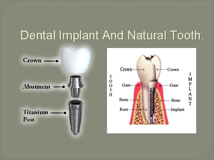 Dental Implant And Natural Tooth. 