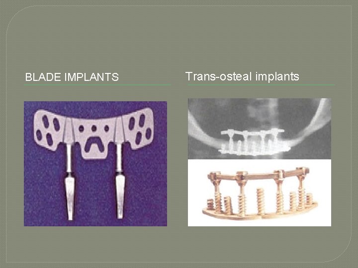 BLADE IMPLANTS Trans-osteal implants 