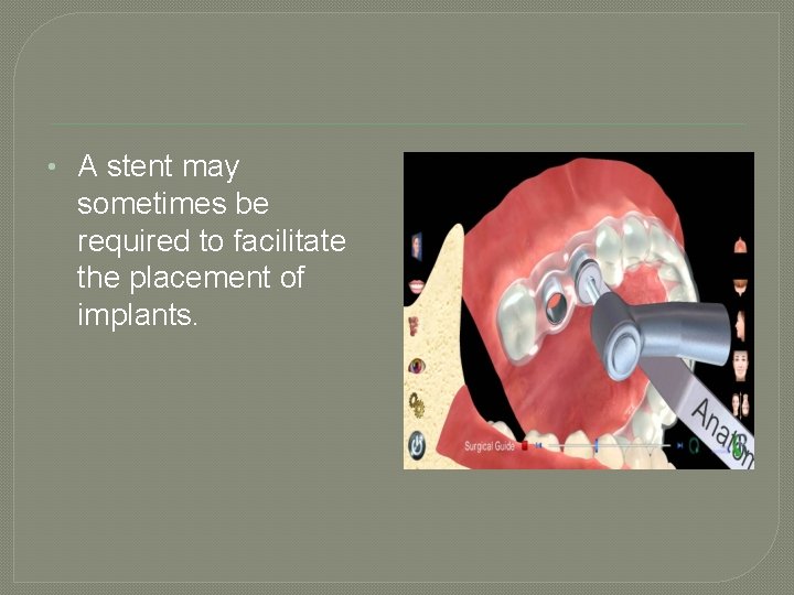  • A stent may sometimes be required to facilitate the placement of implants.