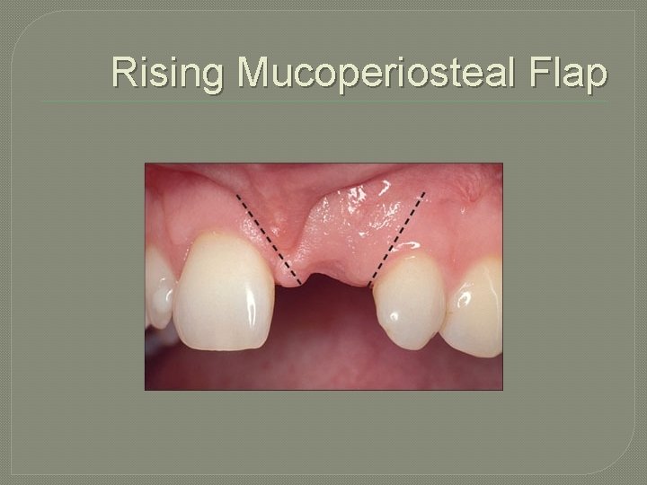 Rising Mucoperiosteal Flap 