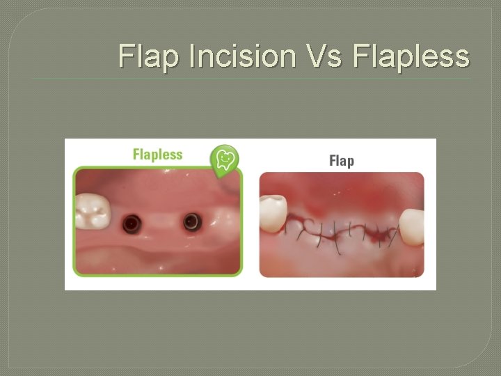 Flap Incision Vs Flapless 