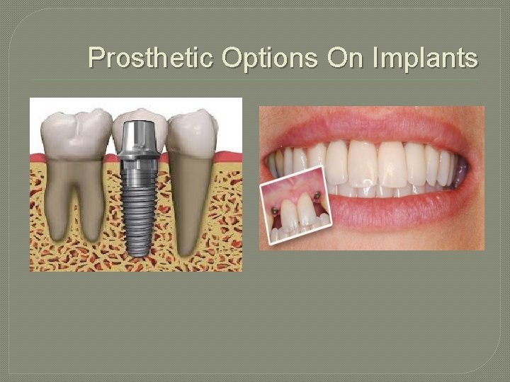 Prosthetic Options On Implants 