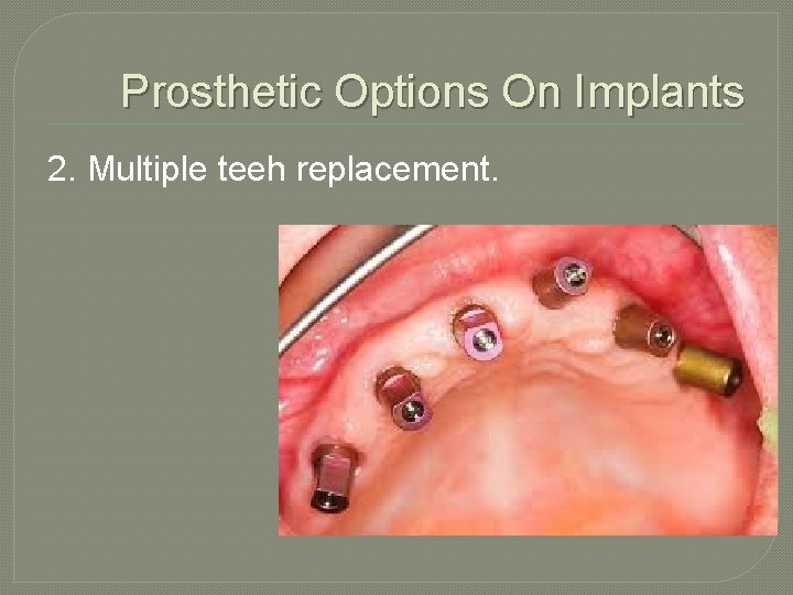 Prosthetic Options On Implants 2. Multiple teeh replacement. 